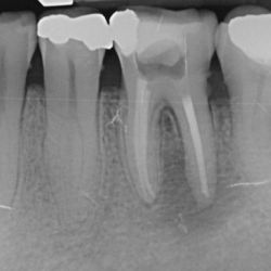 Après le traitement, dent soignée avec pansement